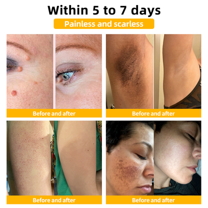 Only 6 boxes left! We are offering an additional 30% off! 💥 Dermatologists recommend 4-6 boxes for complete non-recurrence, so if you miss this opportunity, you'll have to wait until next year!